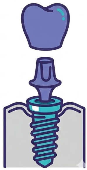 Dental Implant Icon