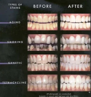 Root Canal Icon
